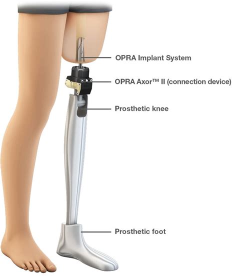 Fda Authorizes Use Of Prosthesis For Rehabilitation Of Above The Knee