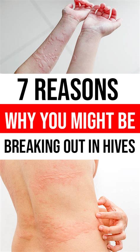 Reasons Why You Might Be Breaking Out In Hives