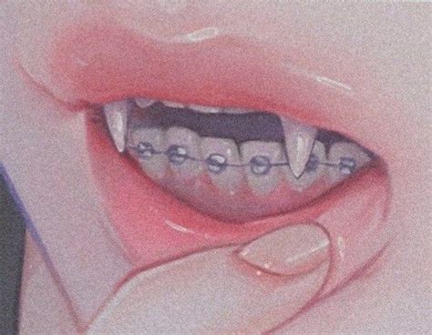 An Open Mouth With Braces And Teeth