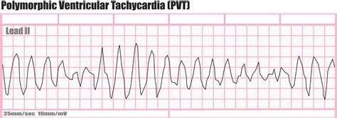 Ventricular Tachycardia Causes Symptoms Diagnosis Prognosis And Treatment