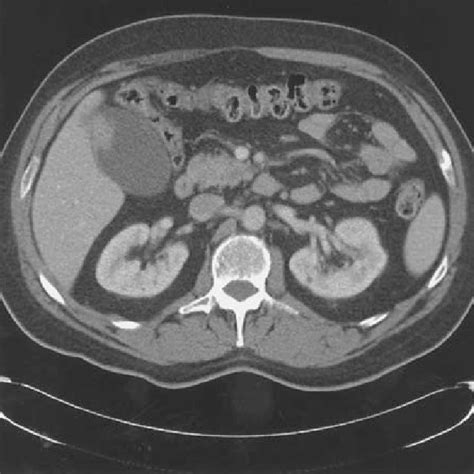 Ct Of Mass In Gallbladder Later Shown To Be Gallbladder Cancer