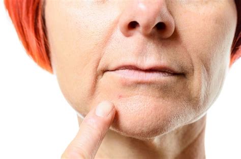 13 Ways To Cure A Blind Pimple Home Remedies