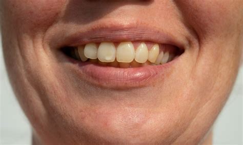 Removing White Spots On Teeth Calcium Deposits