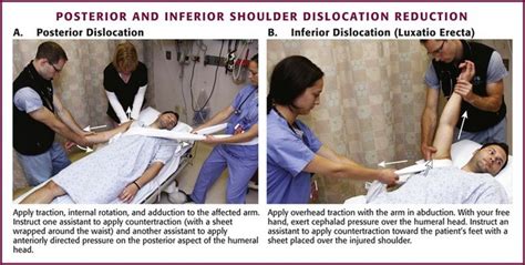 Anterior dislocation is most common, accounting for 95 to 97 percent of cases. Management of Common Dislocations | Veterian Key