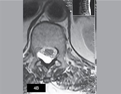 B T2 Weighted Axial Mr Image Demonstrates That The Cyst Has A
