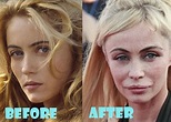 Emmanuelle Beart Plastic Surgery Before and After Pictures - Lovely Surgery