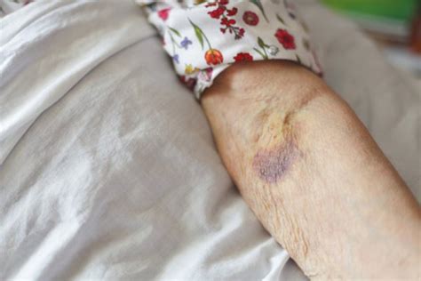 What Is Senile Purpura Causes Symptoms Diagnosis And Treatment Tips