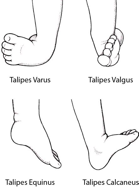 Varus And Valgus Deformity Of The Foot Stock Vector Colourbox