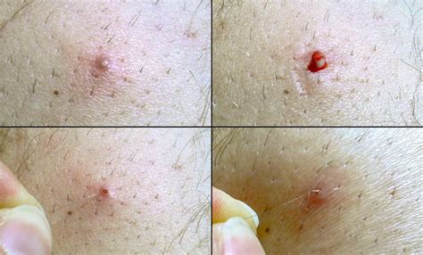 Discover 69 Ingrown Hair On Tattoo Super Hot Incdgdbentre