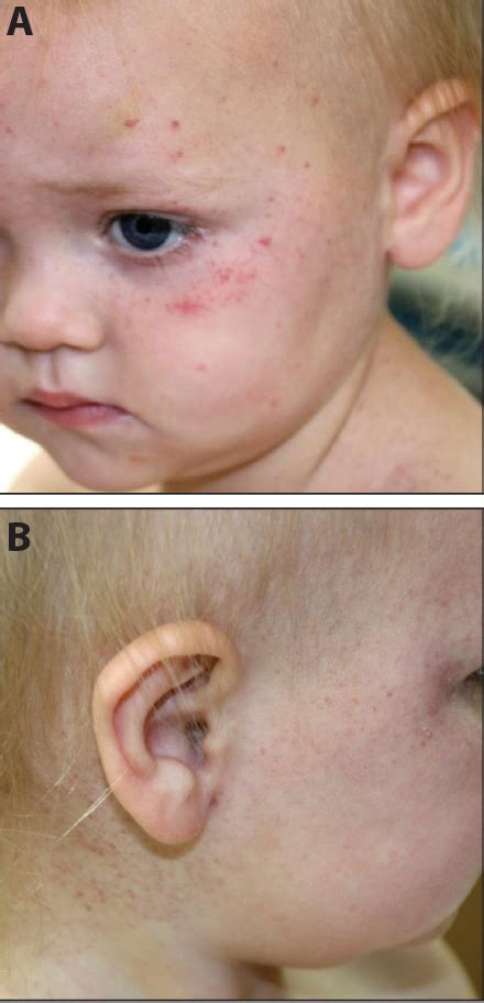 Figure 2 From Petechiae And Purpura The Ominous And The Not So Obvious