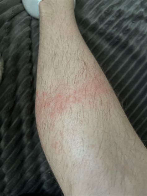 accutane rashes dryness all over the body this has suddenly appeared on my legs arms and
