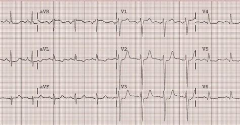 Dr Smiths Ecg Blog Pure Isolated Posterior Stemi Not So Rare