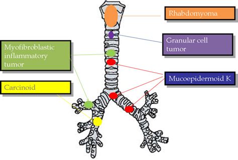 Childhood Tracheobronchial Tumors Treatment Pdq® Pdq Cancer