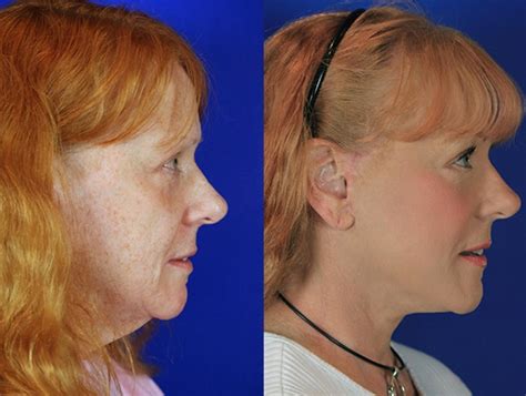 facelift reflection lift before and after photos patient 3 nashville tn youthful