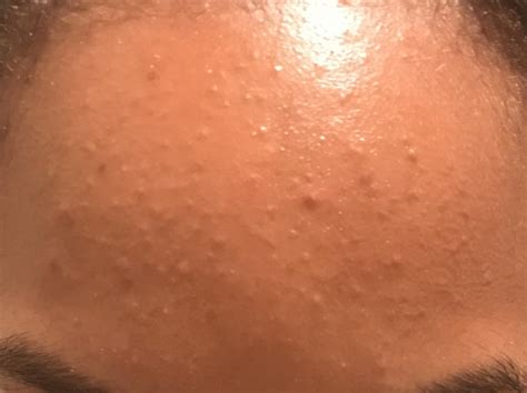Please Help Small Bumps On Forehead Folliculitis General Acne