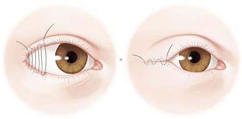 Синдром сухого глаза: причины, симптомы и лечение в статье офтальмолога ...