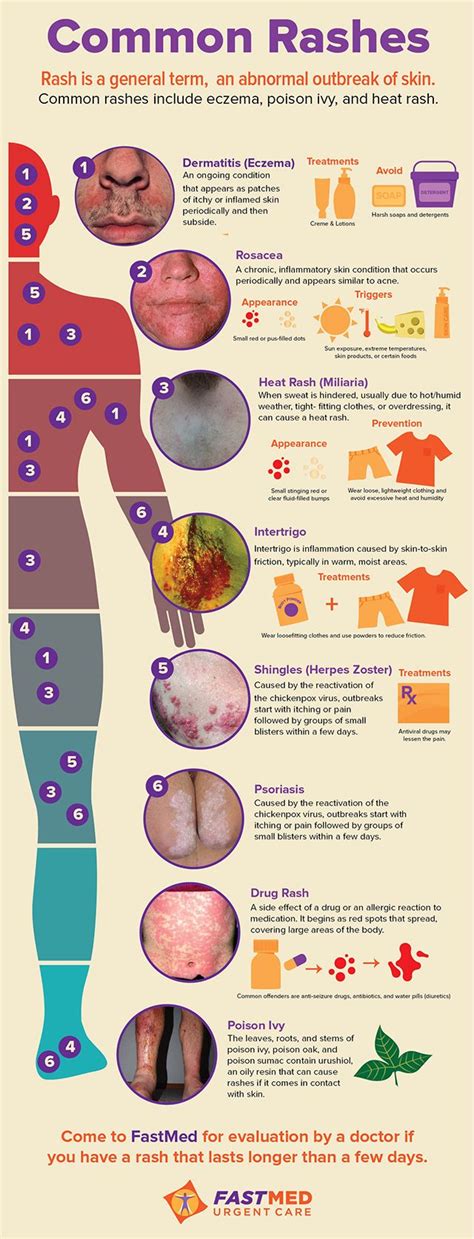 Common Rashes Infographic Skin Itch Rash Common Medical
