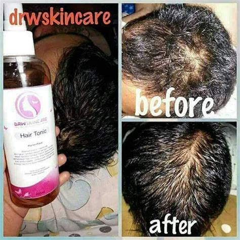 Hair massage seborin water daily for 2 minutes in the scalp. Testimoni Hair tonic Drw Skincare - Agen DRW Skincare