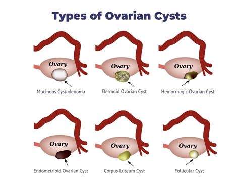Ovarian Cyst Definition Types Symptoms Causes The Best Porn Website