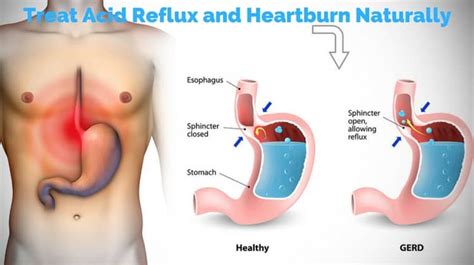 Baclofen may ease gerd by decreasing the frequency of relaxations of the lower esophageal sphincter. Home Remedies to Treat Acid Reflux and Heartburn Naturally