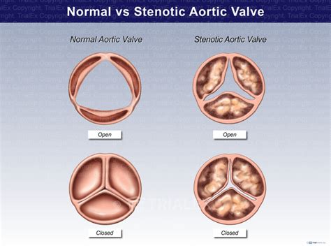 Normal V Stenotic Aortic Valve Trial Exhibits Inc
