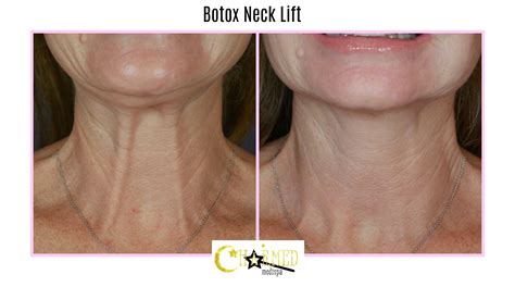 Botox Neck Lift Charmed Medispa