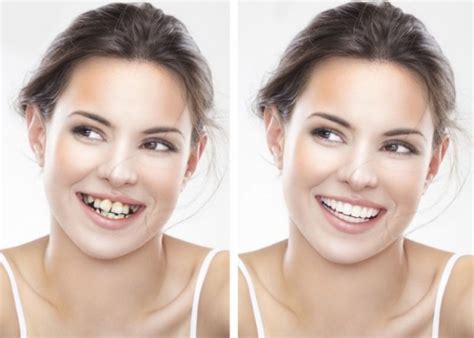 How Do Braces Fix Your Crowded Teeth Or Dis Aligned Teeth Ridgetop