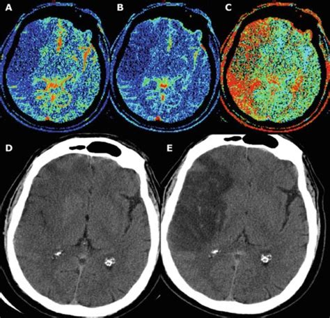 Neuroimaging Methods For Acute Stroke Diagnosis And Treatment