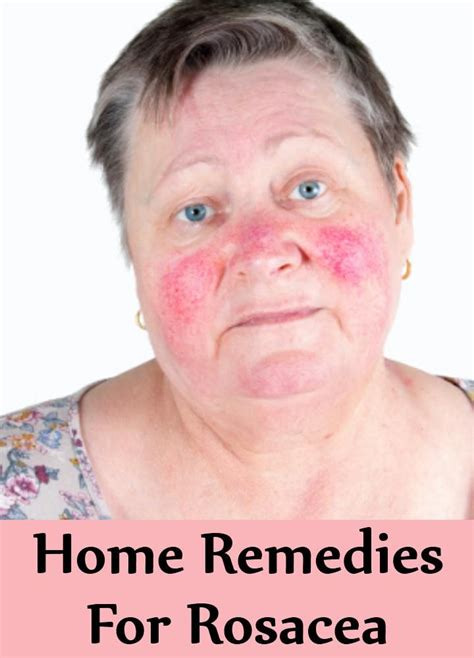 7 Home Remedies For Rosacea Home Remedies For Rosacea Home Remedies