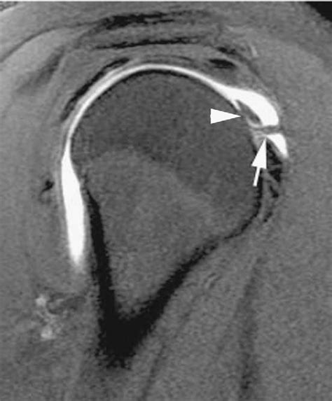 Figure 6 From Mri Of Impingement Syndromes Of The Shoulder Semantic