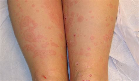 Erythema Multiforme The Clinical Advisor