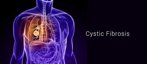 Cystic Fibrosis Screening Highlow Risk For Chromosomal Abnormalities