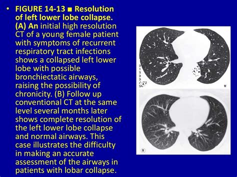 Pulmonary Lobar Collapse Essential Considerations 14 Dr Muhammad Bi