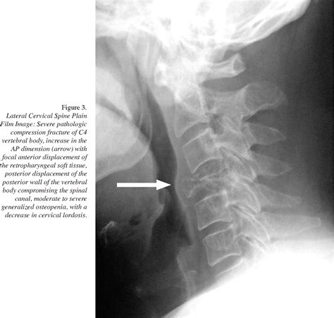 Pdf Pathological Burst Fracture In The Cervical Spine With Negative