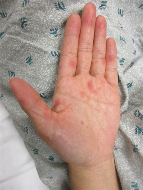 A 24 Yo Asian Woman Presents With A Rash On Her Palms And Soles