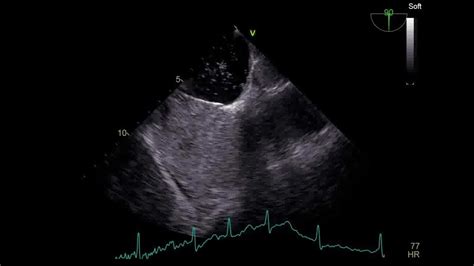 Patent Foramen Ovalepfotee Agitated Saline Bubble Test Afib