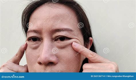 The Flabbiness Adipose Sagging Skin Wrinkles And Ptosis Beside The