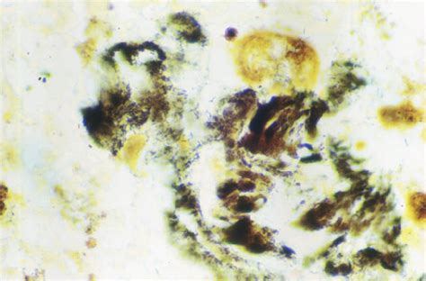 Resected Valve With Bartonella Alsatica Infection Showing Darkly