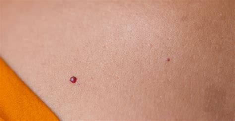 Cherry Angiomas Skin And Laser Center Of Nj