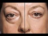 Home Remedies Bags Under Eyes Dark Circles Pictures