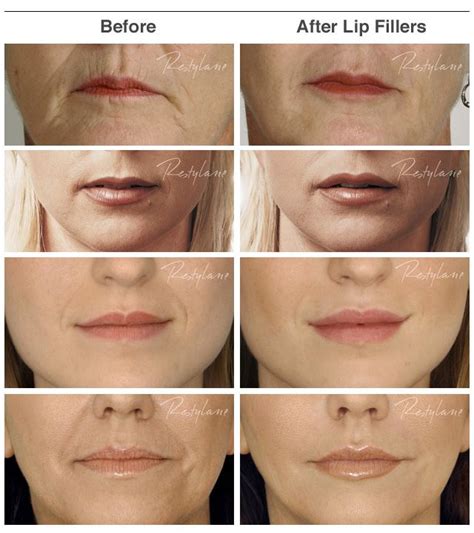 Lip Dermal Fillers Injections Face Clinic London Juvederm Lips Lip