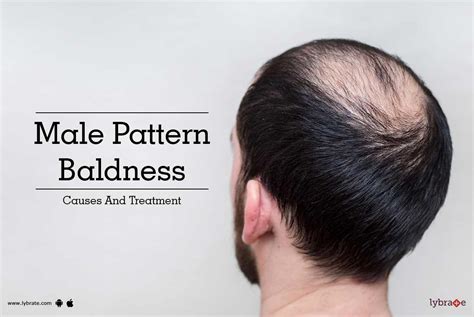 Male Pattern Baldness Causes And Treatment By Dr Rasya Dixit Lybrate