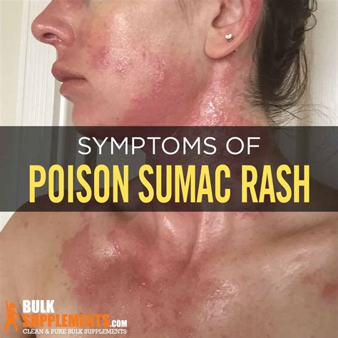 Poison Sumac Skin Rash