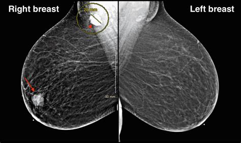 Cureus A Case Report Of Autoimmune Phenomena With Underlying Breast