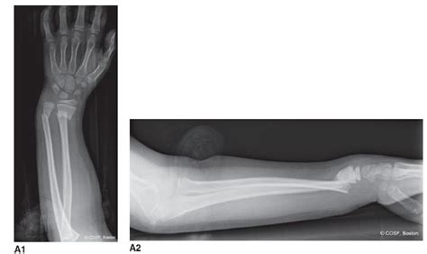 Distal Radius And Carpal Fractures Obgyn Key