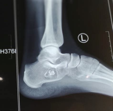 Plain Radiograph Of Left Ankle Lateral View Showing A Lytic Lesion