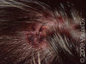 Head Lice Pediculosis Capitis Condition Treatments And Pictures For