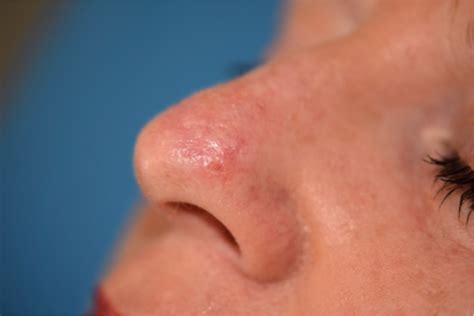 Pink Lesion In The Nose Skin Cancer Blog