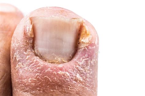 Closeup Of Painful Inflammed Infection Of The Big Toe Due To Ingrown