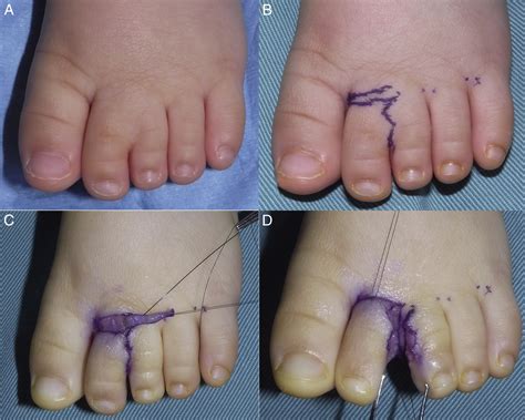 Technique Of Dorsal Transversely Oriented Transposition Flap For Web